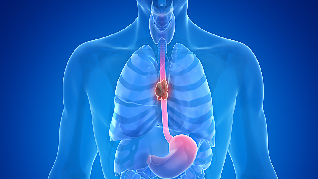 3d rendered medically accurate illustration of esophagus cancer