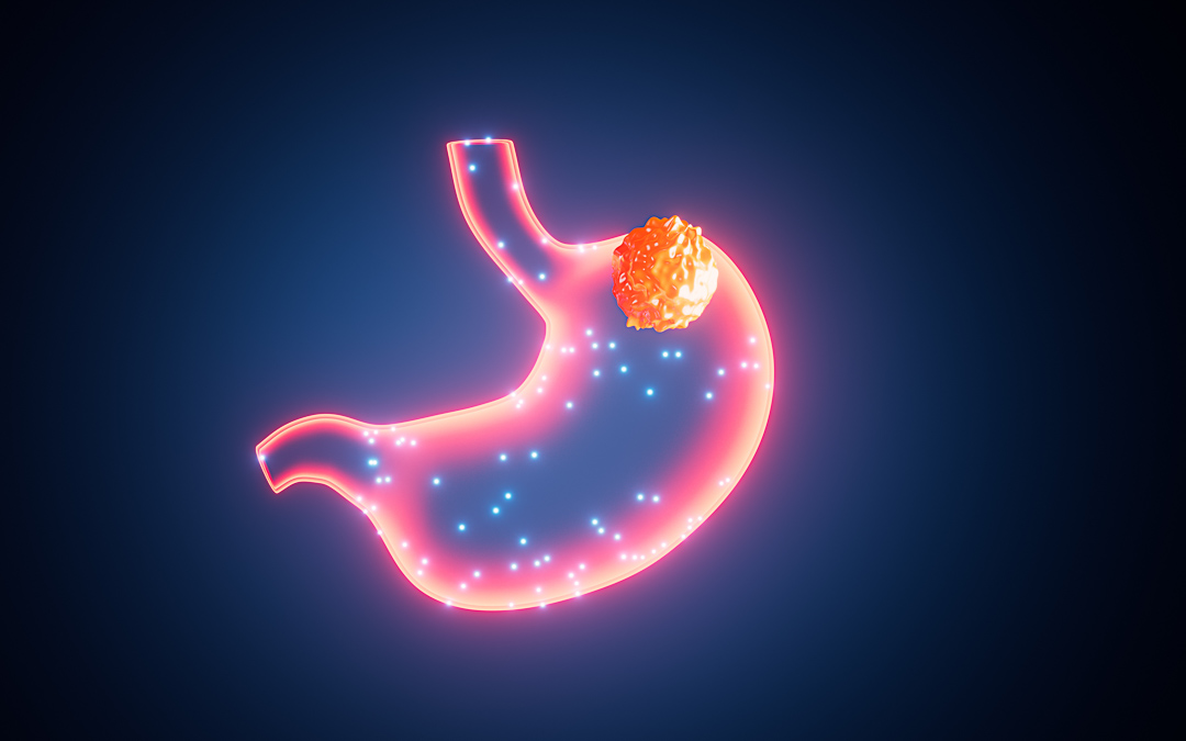Human stomach cancer, gastric cancer, 3d rendering. Digital drawing.